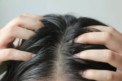 Say Goodbye to Grease: Effective Scalp Treatments for Oily Scalp